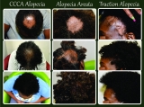 Most Common Types of Alopecia -Hair Loss